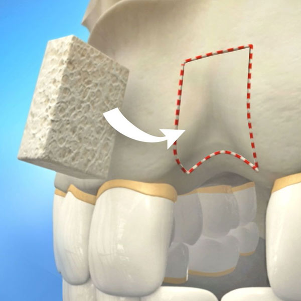 Bone Grafting