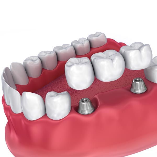 Dental Implants