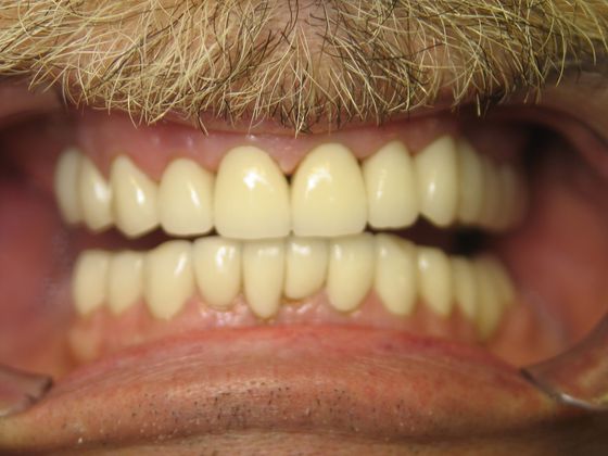Before full mouth reconstruction